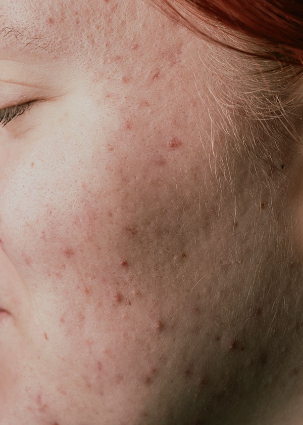 Mujer preocupada por el cané de la piel de su rostro